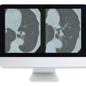 American Roentgen Ray Society Lung Cancer Screening A Comprehensive Guide Online Course 2015
