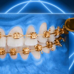 OHI-S Impaction Treatment Author's Protocols, Mistakes and Solutions