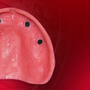 OHI-S Implant-Retained Dentures Innovative Approach to Full-Arch Prosthetics