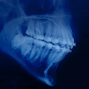 OHI-S Orthodontic treatment in patients with periodontal and alveolar bone pathology