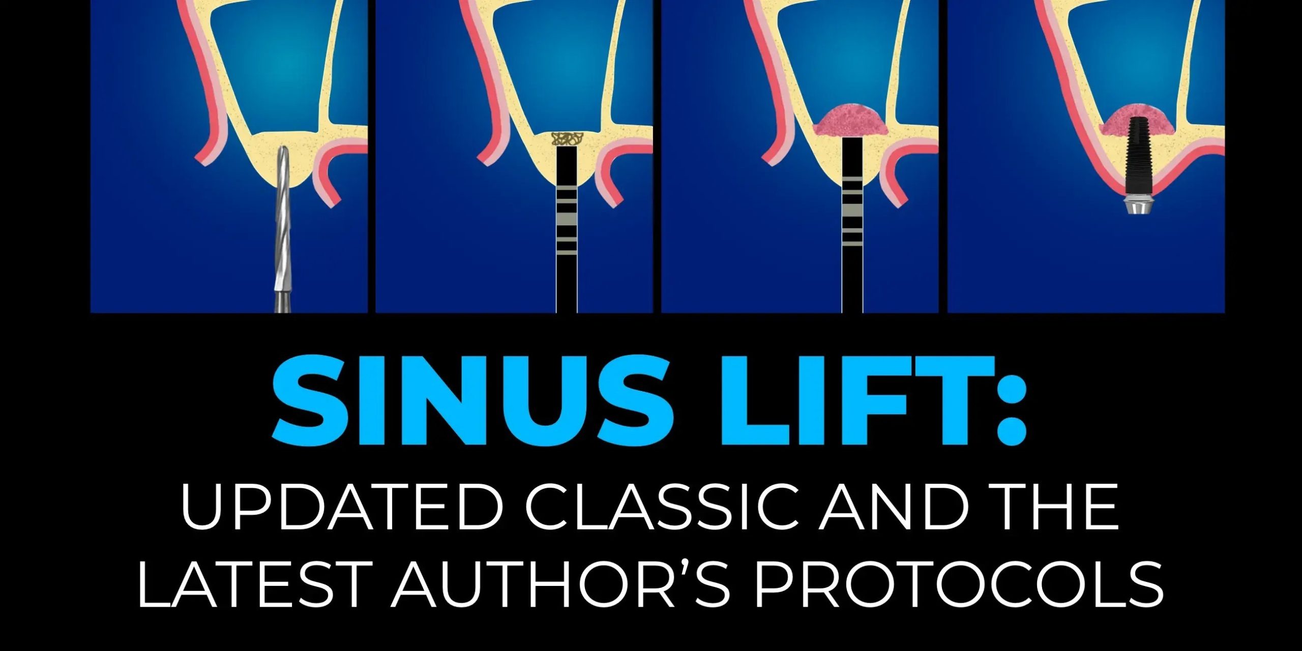 OHI-S Sinus Lift Updated Classic and the Latest Author's Protocols